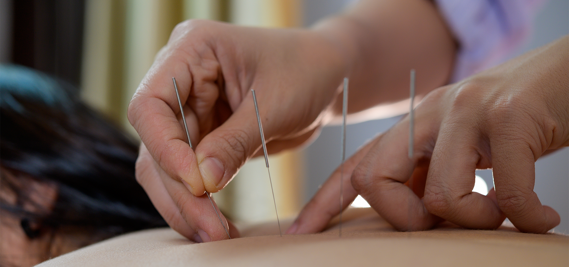 Acupuntura