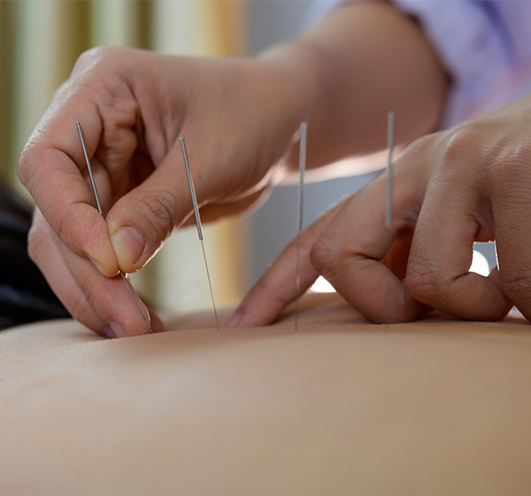 Acupuntura